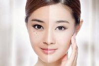 快速祛斑最有效的方法大盘点