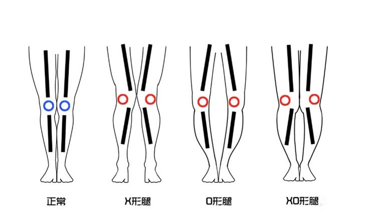 四种腿型